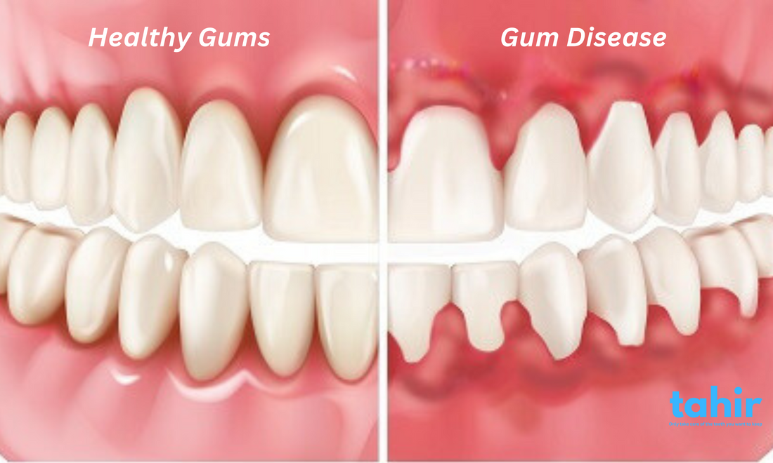Understanding Gum Health: How to Prevent and Treat Gum Disease