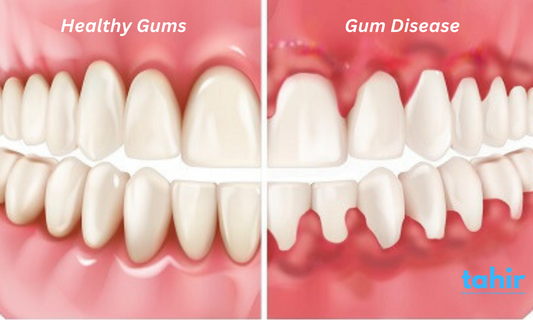 Understanding Gum Health: How to Prevent and Treat Gum Disease