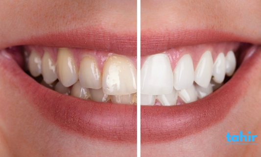Daily Smiles: Keeping Teeth Healthy with Tahir